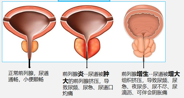 前列腺