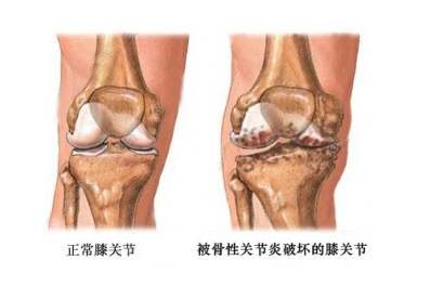 膝关节炎