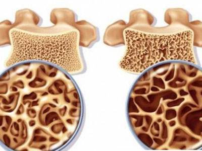 中老年人患骨质疏松是什么原因？