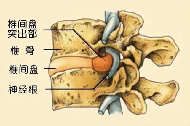 腰椎间盘突出症