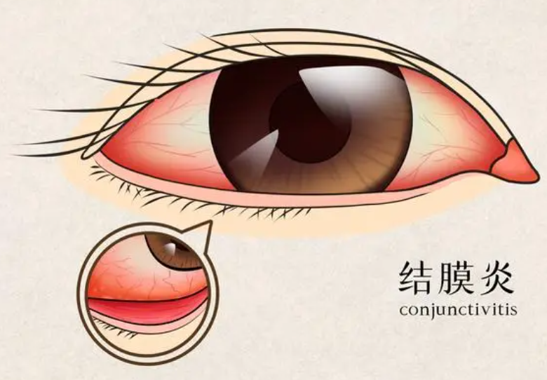 结膜炎