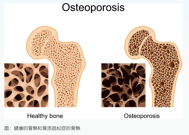 骨质疏松